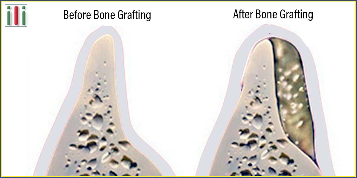 Avoid dental bone grafting, get one-phase implant-based denture